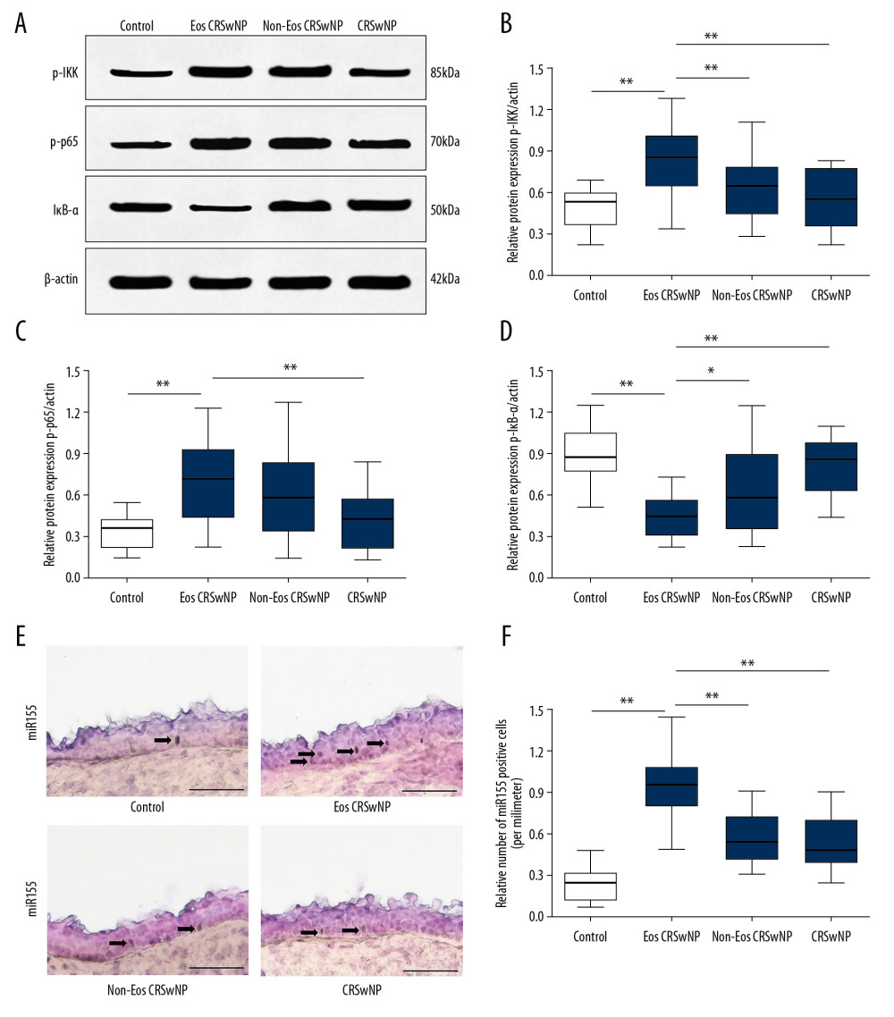 Expression of NF-κB/miR-155 in patients. (A) Western blot analysis of p-IKK, p-p65, and IκB-α in Eos CRSwNP, Non-Eos CRSwNP, CRSsNP, and control group. (B–D) Statistical analysis displayed compared with Non-Eos CRSwNP, CRSsNP, and control group, the expression of p-IKK and p-p65 were significantly elevated while the expression of IκB-α was decreased in Eos CRSwNP group. (E) In situ hybridization of miR-155 in patients. Scale bar=100 μm (F) Statistical analysis displayed the number of miR-155 positive cells were significantly increased in Eos CRSwNP group. * P<0.05; ** P<0.01. NF-κB – nuclear factor κB; CRSsNP – chronic rhinosinusitis without nasal polyps; Non-Eos CRSwNP – non-eosinophilic chronic rhinosinusitis with nasal polyps; Eos CRSwNP – eosinophilic chronic rhinosinusitis with nasal polyps.