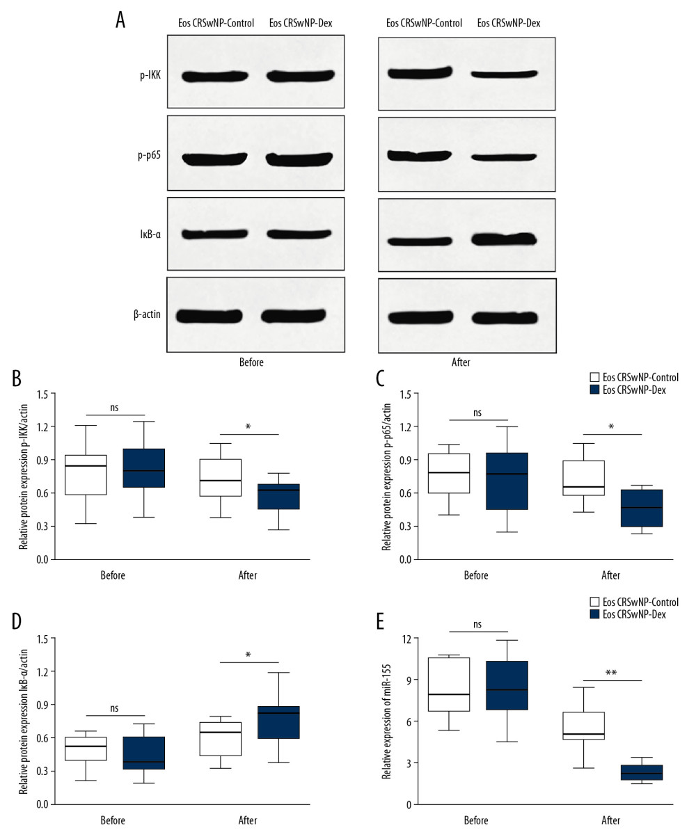Expression of NF-κB/miR-155 in Eos CRSwNP patients with or without DEX treatment. (A) Western blot analysis of p-IKK, p-p65, and IκB-α in Eos CRSwNP-control and Eos CRSwNP-DEX group. (B–D) Statistical analysis displayed after DEX treatment, the expression of p-IKK and p-p65 were significantly decreased while the expression of IκB-α was significantly increased in Eos CRSwNP patients. (E) After DEX treatment, the expression of miR-155 was also decreased in Eos CRSwNP patients. NF-κB – nuclear factor κB; Eos CRSwNP – eosinophilic chronic rhinosinusitis with nasal polyps; DEX – dexamethasone.