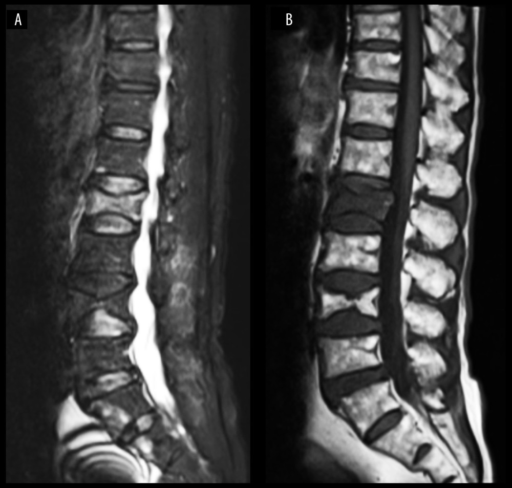 MR images of a representative case with traumatic lumbar before surgery. (A, B) Female, 85 years old, with no obvious traumatic lumbar symptom, but the patient has been in pain for half a month.
