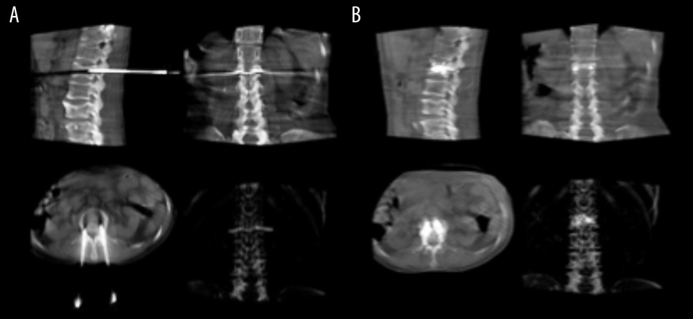 Radiological images of presentative intraoperative puncture, positioning, and injection of bone cement in patients using the double-arm DSA guide.