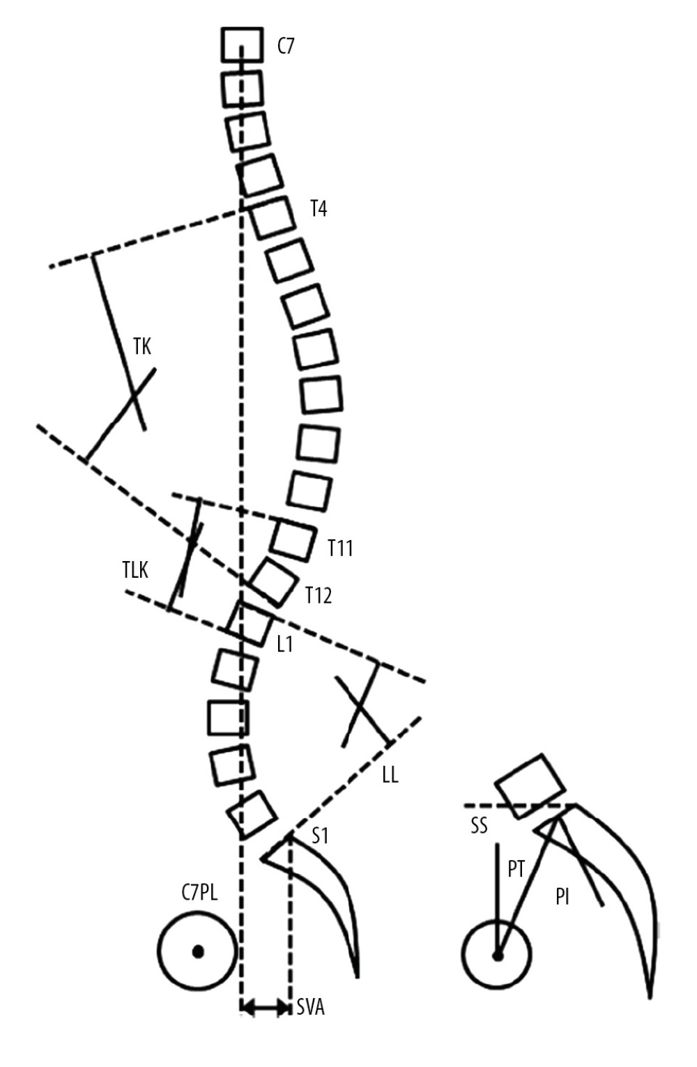 Schematic diagram of the spino-pelvic parameters measurements. TK – thoracic kyphosis; TLK – thoracolumbar kyphosis; SVA – sagittal vertical axis; LL – lumbar lordosis; SS – sacral slope; PT – pelvic tilt; PI – pelvic incidence; C7PL – C7 plumb line.