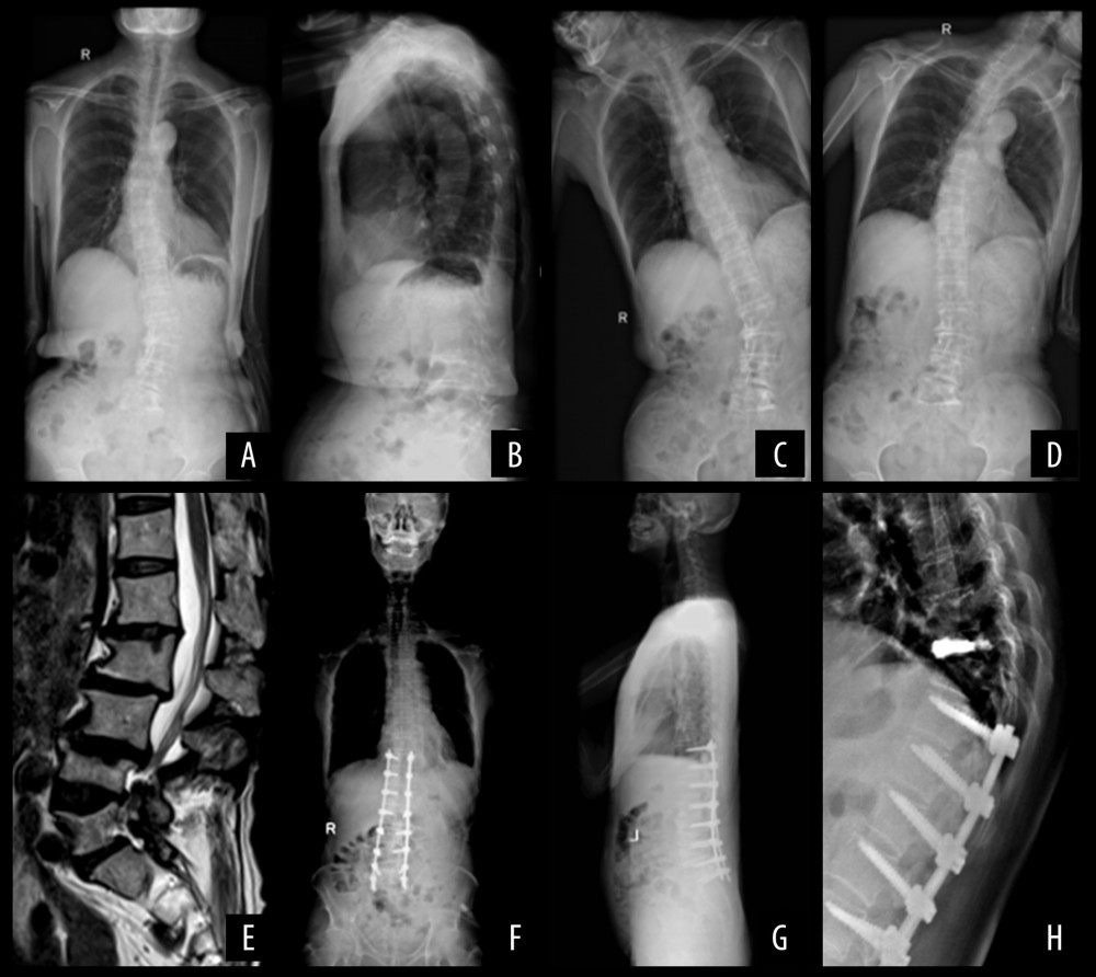 Long-segment fixation. A 65-year-old male patient. (A, B) X-ray films of the whole spine in standard standing position before operation: Cobb angle: 36.35°, SVA: 63.35 mm, TK: 19.63°, TLK: 9.35°, LL: 19.28°, PI: 43.03°, PT: 20.37°, SS: 23.99°; (C, D) The X-ray film of left and right bending position before operation; (E) Sagittal MRI before operation; (F, G) Four months after operation, X-ray films of the whole spine in standard standing position: Cobb angle: 17.41°, SVA: 19.34 mm, TK: 17.53°, TLK: 6.79°, LL: 36.28°, PI: 41.42°, PT: 14.66°, SS: 26.02°; (H) At the eighth month after operation, patients with vertebral compression fractures, and percutaneous vertebroplasty (PVP) was performed.