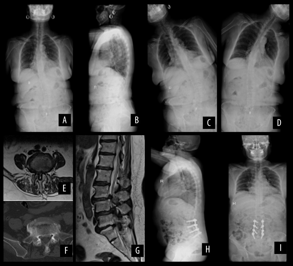 Short-segment fixation. A 63-year-old female patient. (A, B) X-ray films of the whole spine in standard standing position before operation: Cobb’s: 30.13°, SVA: 10.06mm, TK: 12.36°, LL: 28.57°, PI: 44.45°, PT: 21.43°, SS: 24.14°; (C, D) The X-ray film of left and right bending position before operation; (E) Preoperative transaxial plane of MRI showed spinal stenosis; (F) Preoperative transaxial plane of CT scans showed hyperosteogeny at the edge of vertebral body; (G) Sagittal MRI shows disc herniation with dural sac compression; (H, I) One year after operation, X-ray films of the whole spine in standard standing position: Cobb’s: 10.41°, SVA: 34.34mm, TK: 24.53°, TLK: 13.79°, LL: 28.28°, PI: 45.42°, PT: 17.68°, SS: 27.43°.