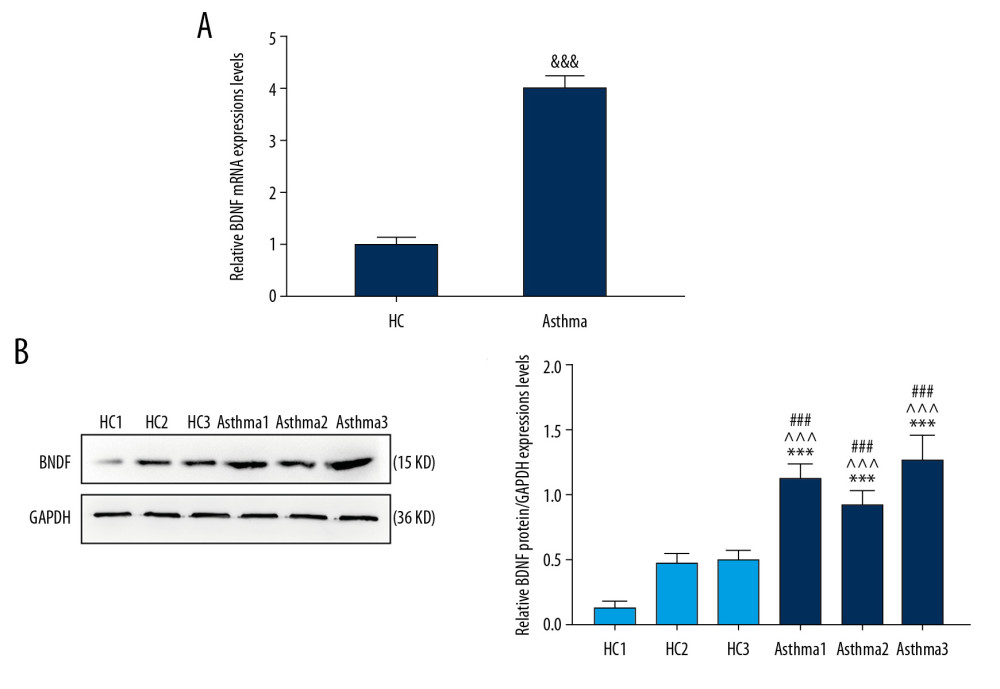 The expression of BDNF in HAECs of asthmatic children was higher than that in the healthy control group. (A) qRT-PCR was used to detect the mRNA expressions of BDNF in newly separated asthmatic HAECs and healthy control HAECs. (B) The protein expression of BDNF in asthmatic and healthy controls was measured through western blot. &&& P<0.001 versus HC, *** P<0.001 versus HC1, ^^^ P<0.001 versus HC2, ### P<0.001 versus HC3, n=3. BDNF – brain-derived neurotrophic factor; qRT-PCR – quantitative real-time reverse transcription polymerase chain reaction; mRNA – messenger RNA; HAECs – human airway epithelial cells; HC – healthy controls.