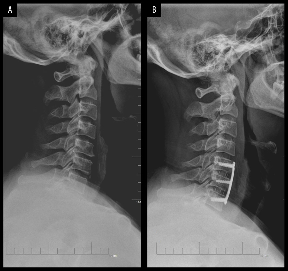 Preoperative lateral X-ray images of (A) a 48-year-old male patient who suffered from severe CSM (C5–C7) and underwent 2-level ACDF (postoperative lateral view), and (B) this patient in the final follow-up visit, showing that the instrumentation is well positioned.