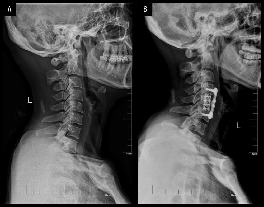 (A) Preoperative lateral view of a 66-year-old female patient who underwent complete recuperation after ACCF (C4–C6). (B) Postoperative lateral view of the same patient in the final follow-up visit, showing a good positioning of the instrumentation.