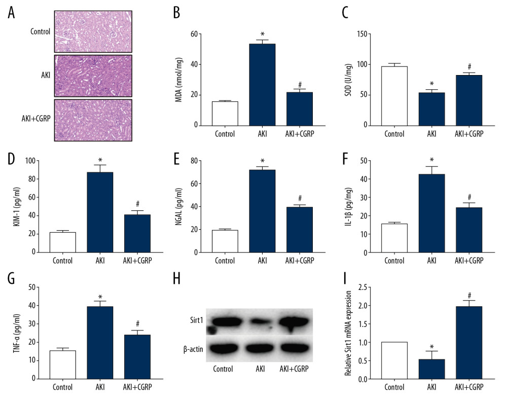 Exogenous CGRP attenuates LPS-induced mouse AKI. (A) HE staining results of mice kidney (magnification ×400); (B) MDA activity in mice kidney; (C) SOD activity in mice kidney; (D–G) ELISA results of KIM-1, NGAL, IL-1β and TNF-α. (H, I) Western blot and RT-PCR results of Sirt1. (* P<0.05 vs. the control group and # P<0.05 vs. the AKI group).