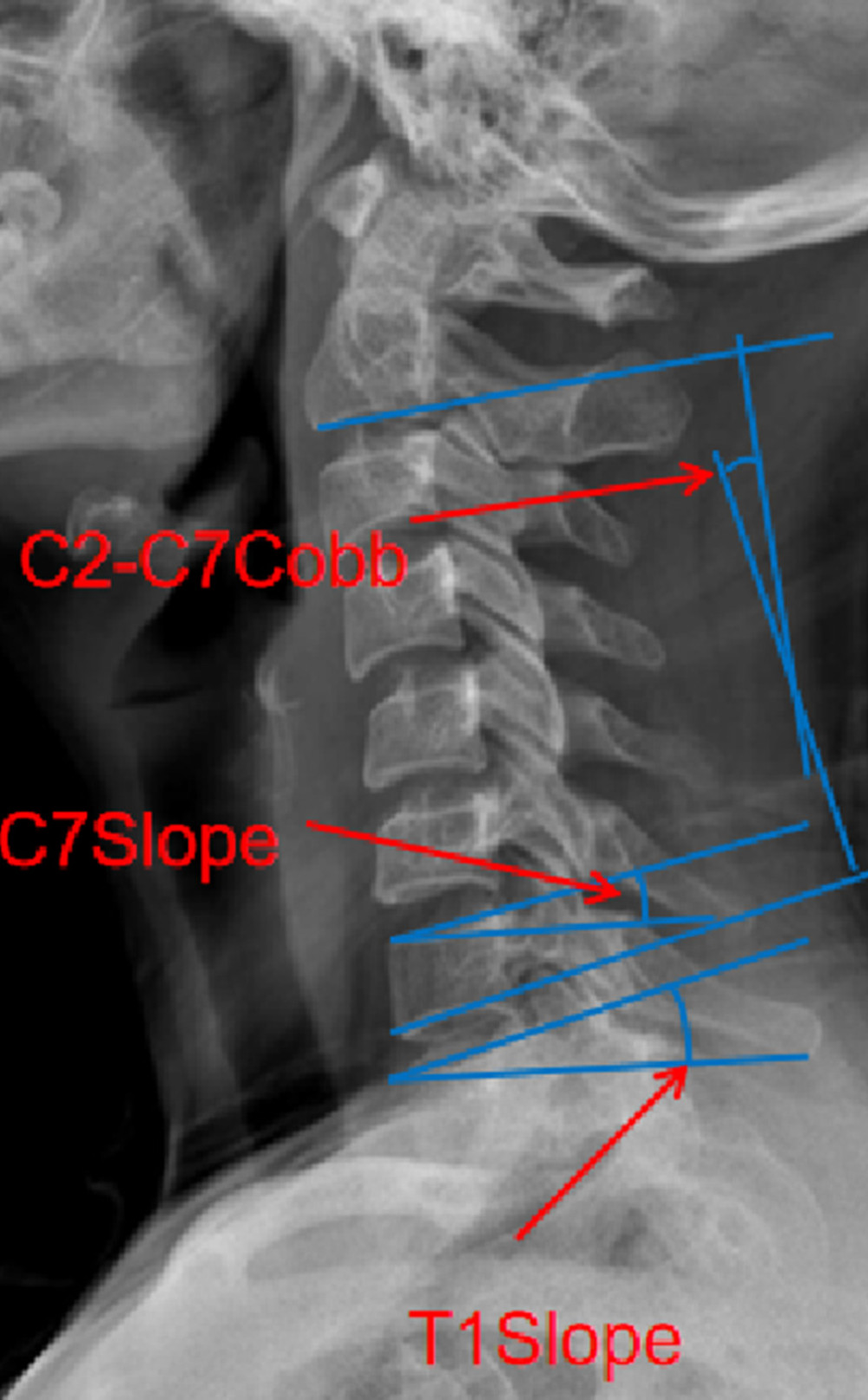 Measurements of the radiological parameters C7 slope, T1 slope, C2–C7 Cobb on a cervical lateral radiograph.