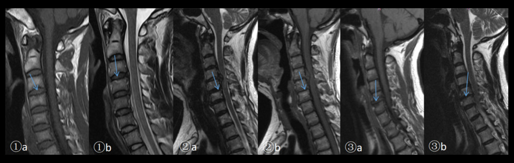 1a. Modic changes type I: A superior C4 vertebral body showed a lower signal intensity on FSET1WI (arrow). 1b. A superior C4 vertebral body showed a higher signal intensity on frFSE-T2WI (arrow). 2a. Modic changes type II: A superior C6 vertebral body showed high signal intensity on FSE-T1WI (arrow). 2b. A superior C6 vertebral body showed high signal intensity on frFSE-T2WI (arrow). 3a. Modic changes type III: A superior C6 vertebral body showed low signal intensity on FSET1WI (arrow). 3b. A superior C6 vertebral body showed low signal intensity on frFSE-T2WI (arrow).