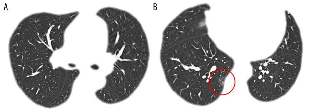 A cluster case of coronavirus disease 2019 (COVID-19). Transverse chest computed tomography (CT) images of a 30-year-old female patient on hospital admission. The patient had symptoms of a cough for three days. (A, B) Ground-glass opacities are shown in the posterior basal segment of the right lower lobe, indicating the presence of interstitial inflammation.