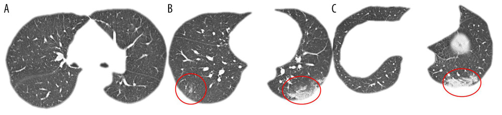 A sporadic case of coronavirus disease 2019 (COVID-19). Transverse chest computed tomography (CT) images of a 32-year-old female patient on hospital admission. The patient had symptoms of a fever and cough for two days. (A–C) Ground-glass opacities are shown in both lower lobes with a ‘crazy-paving’ pattern of lung consolidation in the posterior basal segment of the left lower lobe.
