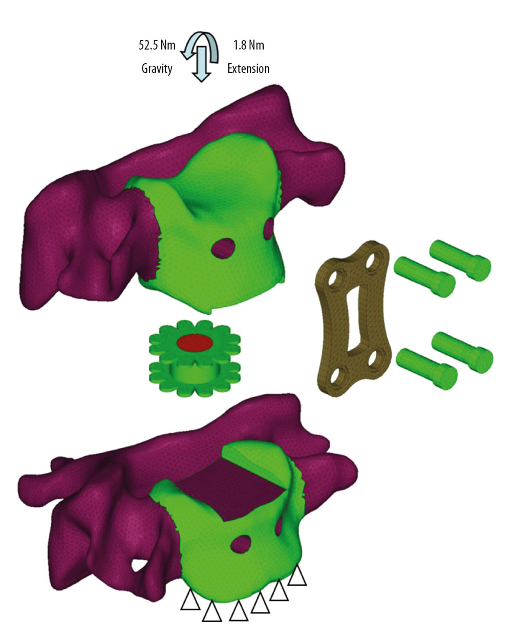The C5–C6 FE model with cage implantation and its boundary and loading condition. A uniform compression force of 52.5 N mimicking the gravity of head, and a moment of 1.8 Nm mimicking the flexion motion pattern was exerted on the vertebrae of C5, while the nodes at the bottom of C6 were completely constrained.