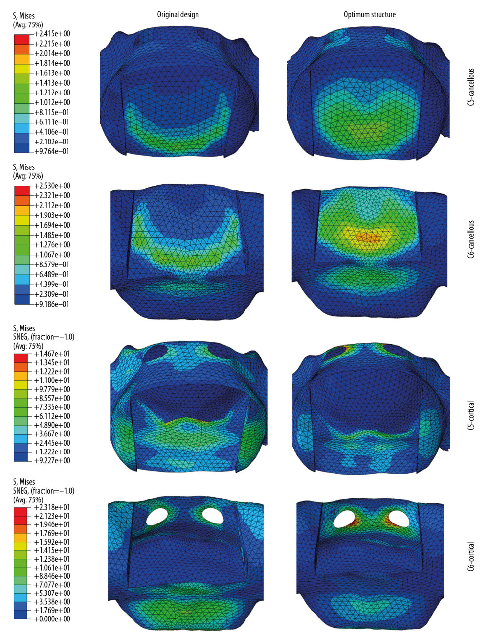 The stress distribution on cancellous and cortical bone of C5 and C6 for the original cage and optimum structural one.