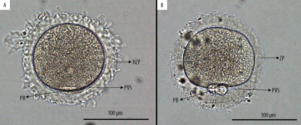 Human mature oocytes. (A) Oocyte with heterogeneous zona pellucida. The perivitelline space is extremely reduced or absent. (B) Oocyte with normal zona pellucida. Scale bar – 100 μm. ZP – zona pellucida; PB – polar bodies; PVS – perivitelline space.