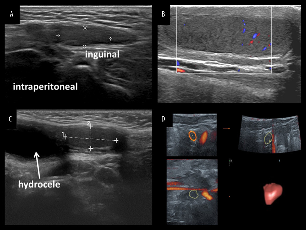 Ultrasonography of undescended testicle and volume measurement by VOCAL technique. (A) Inguinal clear boundary and reduced volume; (B) Prescrotal cryptorchidism with uneven echo and sparse perfusion; (C) Cryptorchidism with patent processus vaginalis (D) Testicular volume measured by 3-dimensional ultrasound VOCAL technique.