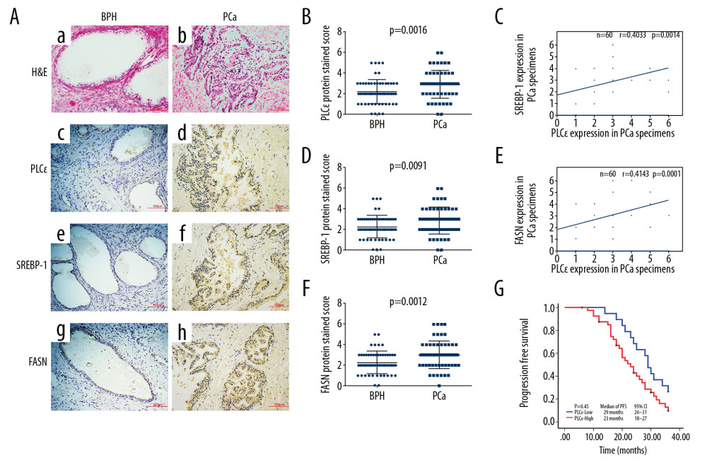 High expression of PLCɛ in PCa tissue specimens is related with SREBP-1/FASN. (A) Hematoxylin and eosin (HE) staining was performed on BPH and PCa tissue specimens, and PLCɛ, SREBP-1, and FASN expression levels were detected by immunohistochemistry (IHC) (200×, 100 μm bar) (a–h). (B–D) Staining scores for SREBP-1, FASN, and PLCɛ in BPH and PCa specimens. (E, F) The correlation between SREBP-1 and PLC and between FASN and PLCɛ in PCa tissue specimens was examined by Spearman analysis. (G). Progression-free survival in PCa patients was analyzed by Kaplan-Meier survival analysis.
