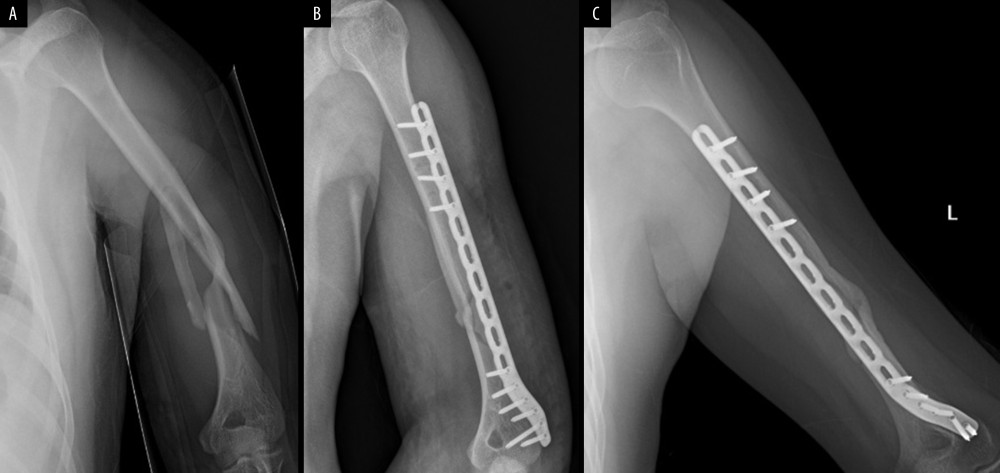 X-ray films of a 25-year-old male with left mid-humeral shaft fracture caused by traffic accident treated via the anterolateral approach (AO type C): (A) before surgery; (B) at immediate after surgery; (C) at 12 months after surgery.
