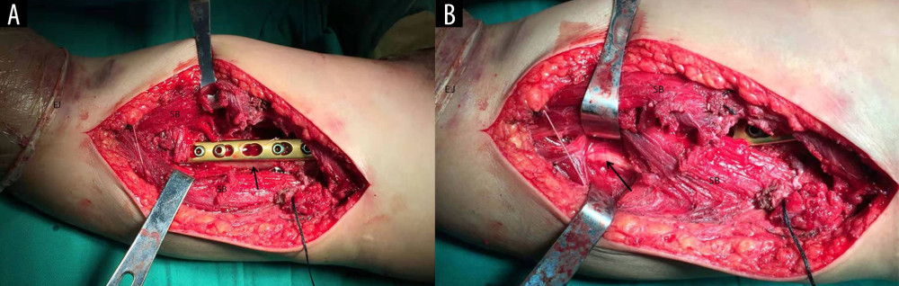 Anterolateral approach used in all cases of group II and IV. (A) arrow, humeral shaft; (B) arrow, radial nerve. SB – split brachialis; EJ – elbow joint.