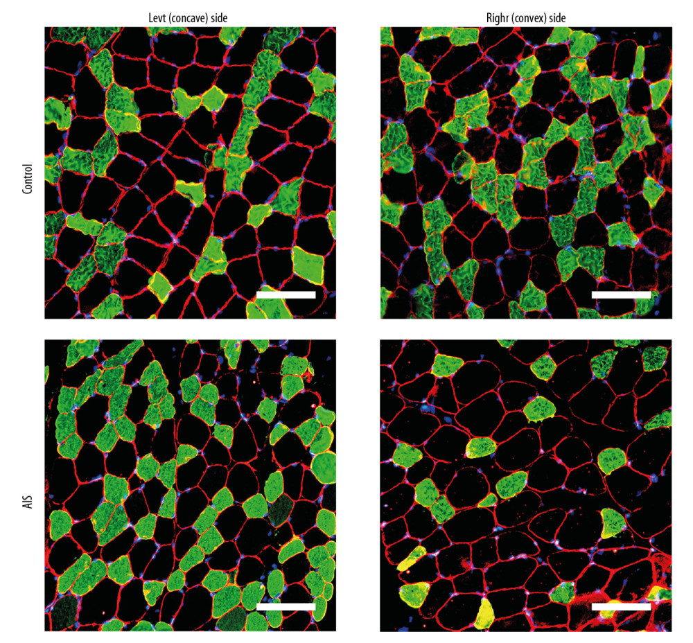 Representative bilateral paraspinal muscle immunohistological images of laminin 2 alpha (red), fast myosin skeletal heavy chain (green), and DAPI (blue) from individuals with adolescent idiopathic scoliosis and control individuals. The cross-sectional area is surrounded by laminin border. Muscle fiber type II can be stained with green while fiber type I cannot. Myonuclei were determined by DAPI+ cells within the laminin border. Scale bar=100 μm.