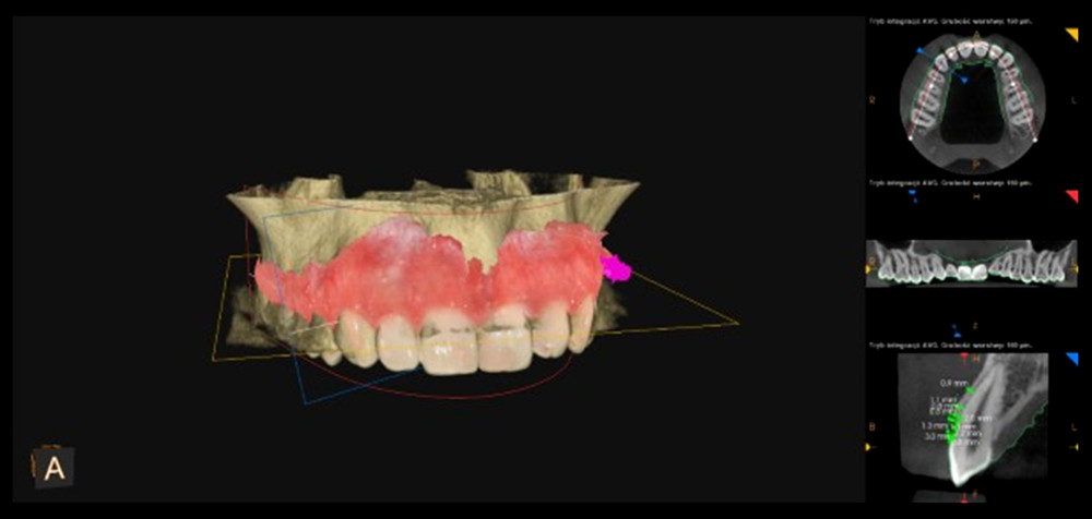 3D visualization after superimposing the standard tessellation language files generated by intraoral scanning and Digital Imaging and Communications in Medicine files generated by cone-beam computerized tomography imaging using PDIP® software (Prosthetic-driven Implant Planning, Carestream Health, France).