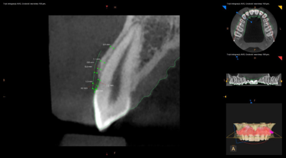 The final visualization of the radiological measurement of evaluated parameters at dentogingival unit 13 without auxiliary sections.