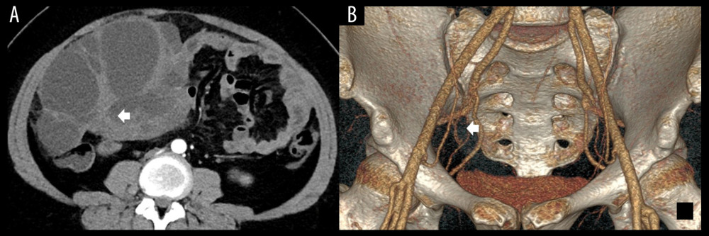 (A) The enhanced axial multidetector computed tomography images of a 32-year-old female with SBOTs showed a solid-cystic mass with thick wall and thick septa (arrow); however, with few vascular abnormalities in the endophytic part of the tumor. (B) The reformat in VR algorithm. Scant tiny vessels in the endophytic part of the tumor (arrow). SBOTs – serous borderline ovarian tumors; VR – volume rendering.