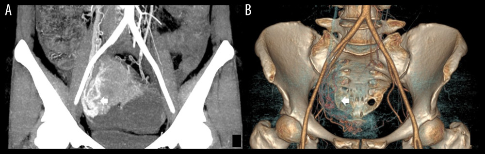 (A, B) Multidetector computed tomography arterial phase of a 67-year old woman with SMOT. The reformat in MIP and VR algorithm. Early venous outflow as an indirect sign of arteriovenous shunting in solid parts of the tumor (arrow). SMOT – serous malignant ovarian tumor; MIP – maximal intensity projection; VR – volume rendering.