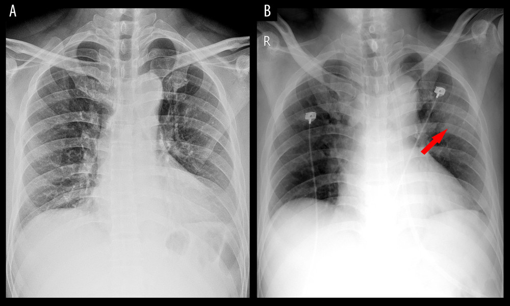 Chest radiography image of a COVID-19-infected patient. A 50-year-old man with a 2-day history of fever and cough. At first, there was no abnormality in the chest radiography image except for a mild enlarged cardiac shadow (A). Two days later, a local patchy shadow was found in the outer band of the left lung (arrow) (B).