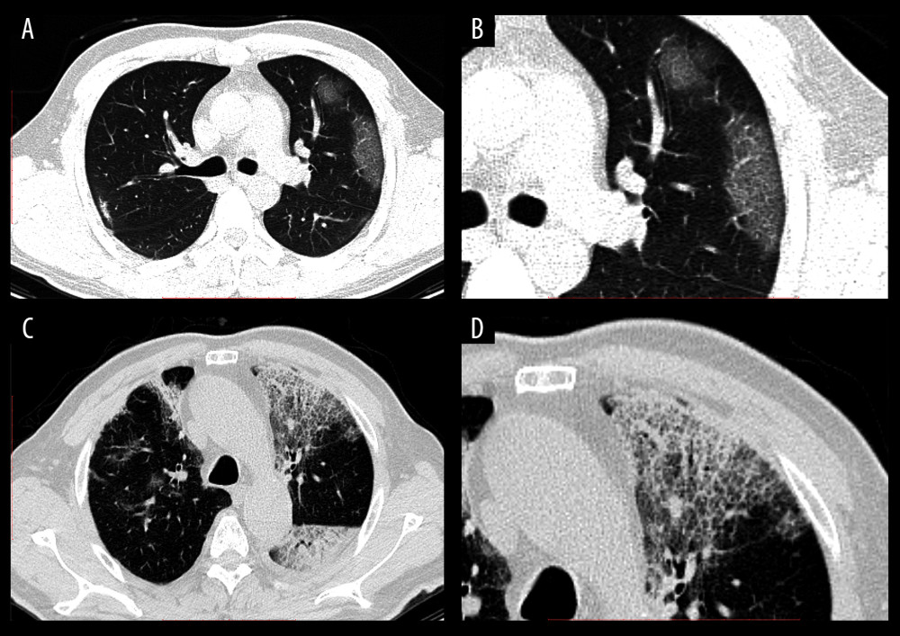 CT images of confirmed COVID-19-infected patients. (A) A 37-year-old man with a 3-day history of fever and cough. The chest CT image showed GGOs with peripheral distribution in the lung. (B) Local amplification of the GGOs. (C) A 70-year-old man with a history of type 2 diabetes mellitus and hypertension. On the seventh day after coming back from Wuhan, he had fever and cough. Reticular interlobular septal thickening and typical crazy-paving pattern were shown by chest CT images. (D) Local amplification of crazy-paving pattern.