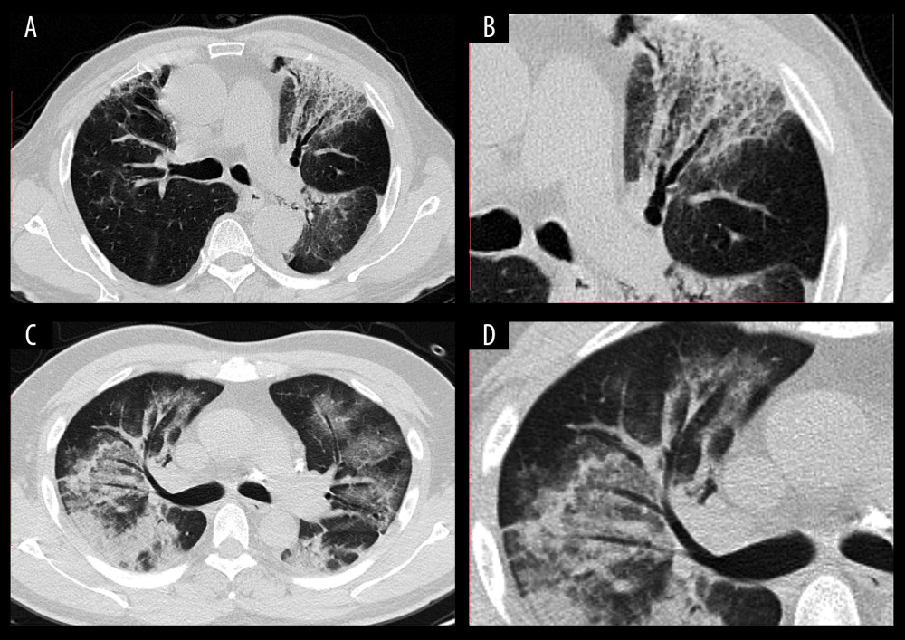 CT images of confirmed COVID-19-infected patients. (A) A 70-year-old man with fever (38.5°C), cough for three days, and had a travel history of Wuhan City. Chest CT displayed patchy GGOs with bronchial wall thickening in the left upper field. (B) Local amplification of the bronchial wall thickening. (C) A 50-year-old male with a residence history of Wuhan City. He had his first visit to our hospital on January 25, 2020, because he had a fever and cough for two days. Chest CT acquired on February 1, 2020, showed multiple subpleural distributed GGOs with consolidation lesions. An air bronchogram sign could be found in the right lung lobe. (D) Local amplification of the air bronchogram sign.