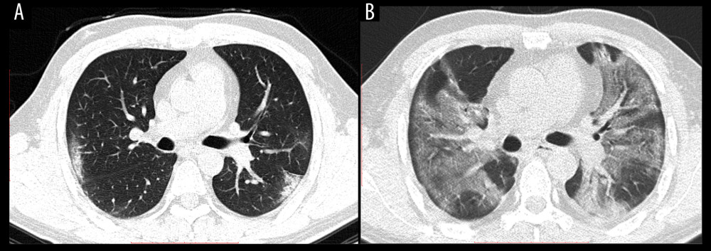A 37-year-old man with a 3-day history of fever and cough. He had a history of close contact with COVID-19 confirmed cases and later he was confirmed to be COVID-19-infected by RT-PCR. (A) The first chest CT acquired on February 12, 2020, showed small GGOs in the bilateral lungs. (B) Eight days later, follow-up chest CT showed the GGOs developed rapidly. The size and range of the lesions increased, which indicated the deterioration of the disease.