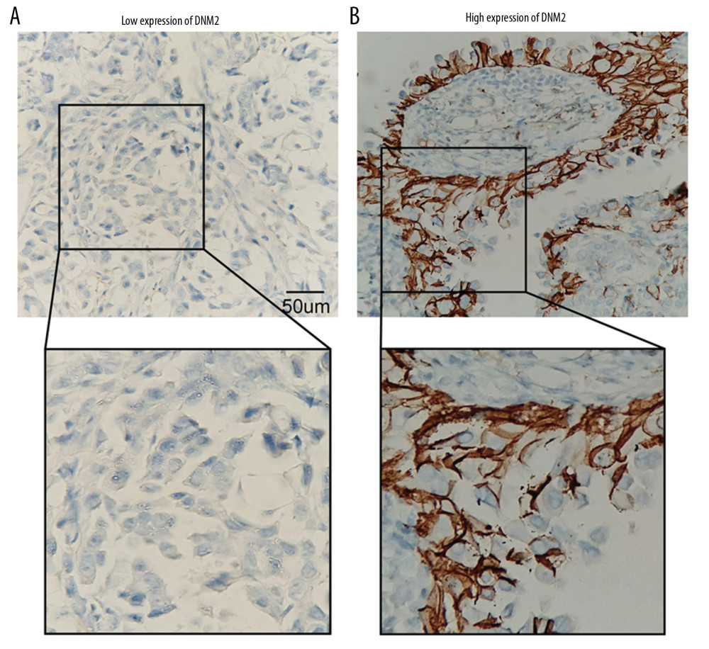 Expression of dynamin 2 (DNM2) in papillary thyroid cancer (PTC). Expression of DNM2 was investigated in 112 cases of PTC; patients were classified into low (A) and high (B) expression. The immunohistochemistry scores of (A) and (B) were 15.2 and 132.4, respectively.