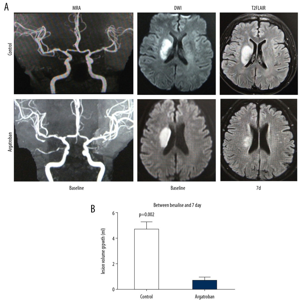 Impact of argatroban on lesion volume growth in patients. (A) MRI images show acute right hemisphere infarct with middle cerebral artery stenosis in a control patient (top) and acute right hemisphere infarct with middle cerebral artery stenosis in an argatroban-treated patient (bottom). Lesion volumes were measured on a DWI (baseline) and T2FLAIR (day 7). (B) Growth of lesion volume from baseline to day 7. Lesion growth equals lesion volume measured on T2FLAIR at day 7 minus that measured on DWI at baseline. Data are presented as mean±SD. An independent t-test was conducted for each comparison. MRI – magnetic resonance imaging; DWI – diffusion weighted imaging; SD – standard deviation.