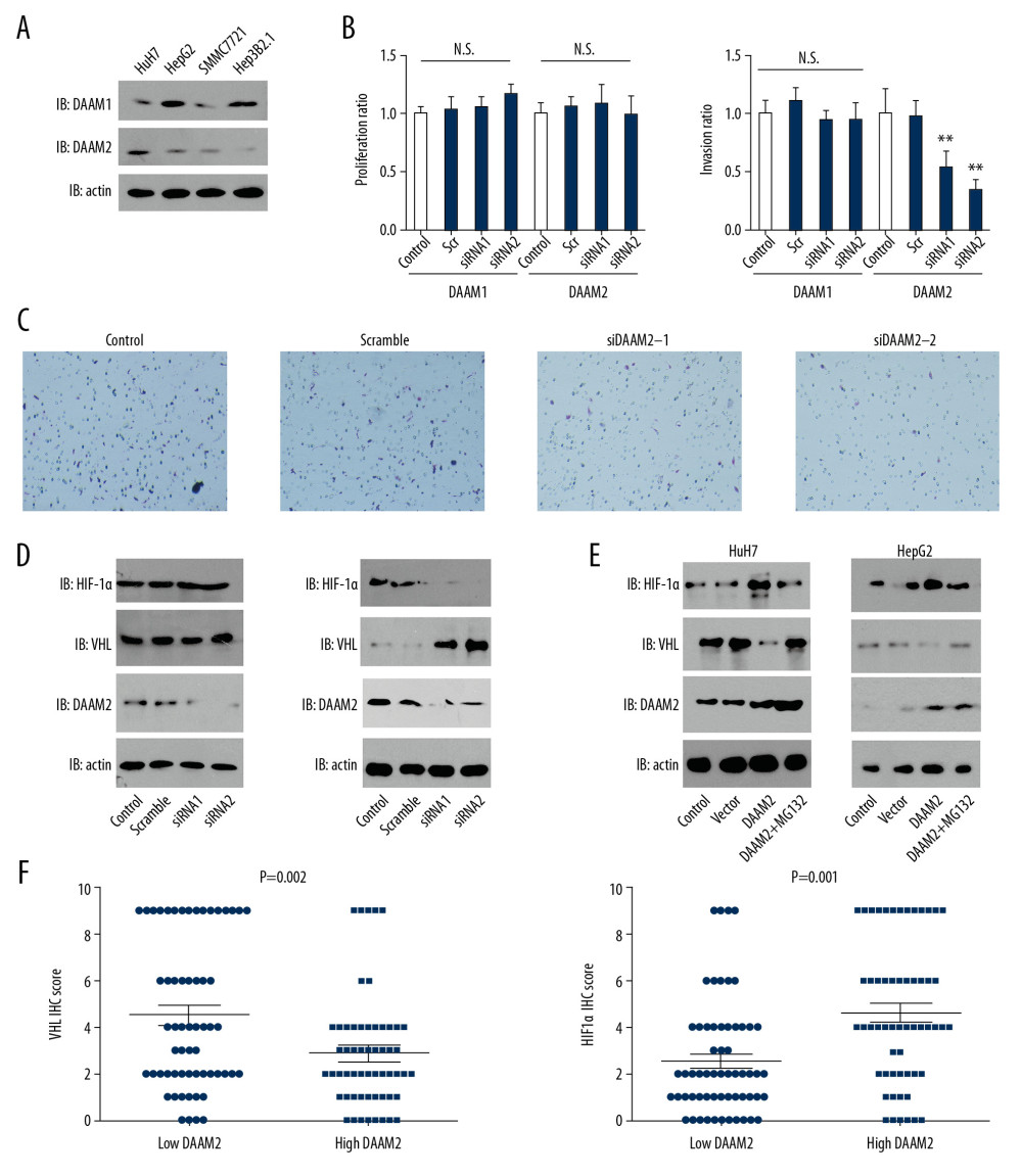 DAAM2 decreased VHL and up-regulated HIF-1α in a ubiquitin-dependent pathway. (A) Expressions of DAAM1 and DAAM2 in different HCC cell lines. (B) Cell proliferation (left) and invasion (right) were detected with MTT assay and transwell assay, respectively, after silencing DAAM1 or DAAM2 expression by siRNA. DAAM1 was silenced in HepG2 while DAAM2 was knocked down in HuH7. N.s. represented not significant and ** meant P<0.01 compared with the control group. (C) Representative images of HuH7 cells transfected with scrambled siRNA, siDAAM2-1 and siDAAM2-2 in transwell assay. (D) Expression of VHL and HIF-1α was detected with Western blot 48 hr after knocking down DAAM1 or DAAM2. DAAM1 was silenced in HepG2 while DAAM2 was knocked down in HuH7 (E). In HuH7 and HepG2, expression of VHL and HIF-1α was detected 48 hr after transfection of empty vector or plasmid carrying DAAM2, in the presence or absence of 10 μM G132 for 6 hr. (F) In the 117 patients with HCC, patients with high DAAM2 expression had lower VHL IHC score and higher HIF-1α IHC score.