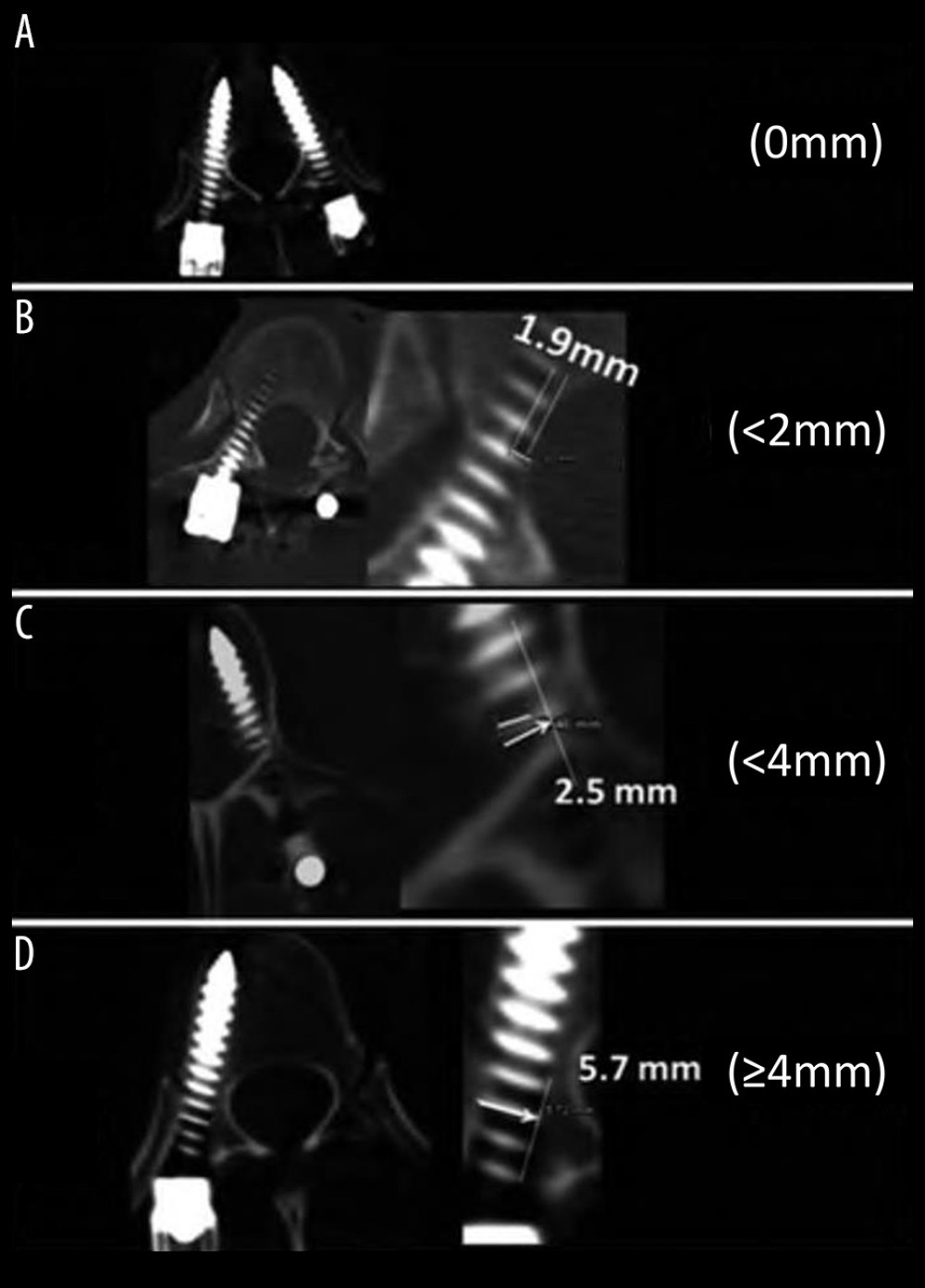 (A–D) Rampersaud classification according to CT scans shows the deviation of the screw from the optimal trajectory.