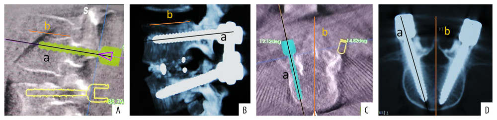 (A, B) Intraoperative 3D image and sagittal image reconstructed by postoperative CT scan; Deviation sagittal = B (postoperative angle between auxiliary line a and auxiliary line b) – A (intraoperative angle between auxiliary line a and auxiliary line b). (C, D) Intraoperative 3D image and transversal image reconstructed by postoperative CT scan; Deviation transversal – D (postoperative angle between auxiliary line a and auxiliary line b) – C (intraoperative angle between auxiliary line a and auxiliary line b).