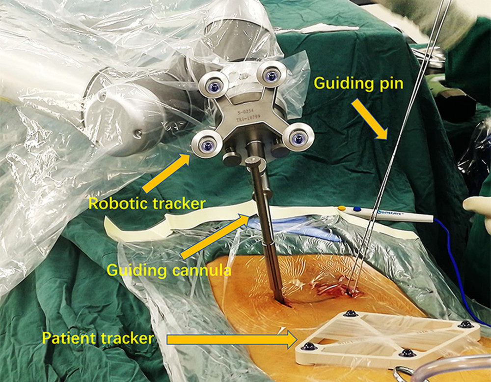 Detail shows guiding pin insertion with assistance of Tinavi robot system.