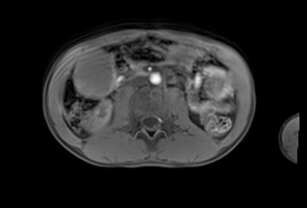 An 11-year-old child patient with mesenteric lesions, abdominal mass is shown in a magnetic resonance image.
