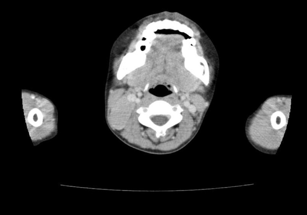 A 10-year-old child patient, the right cervical mass is shown in a computed tomography examination.
