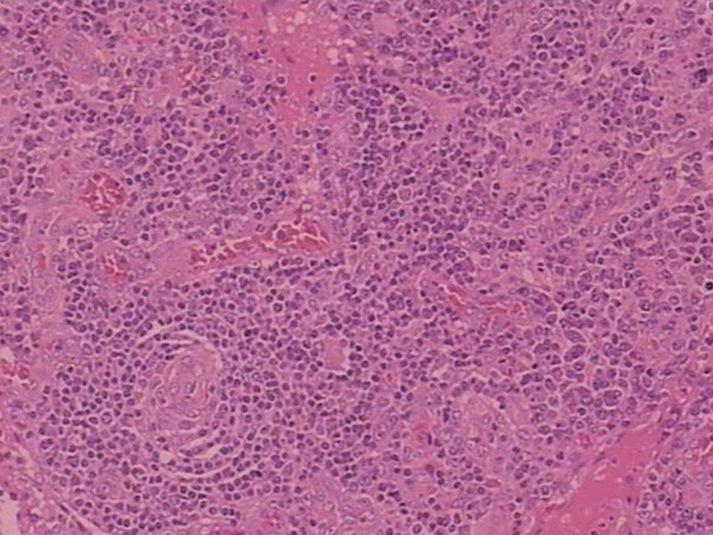Hematoxylin and eosin staining. Lymph nodes are unclear, the lymphoid sinus is expanded, sinus histiocytosis is obvious, and there is proliferation of small vessels in some areas.