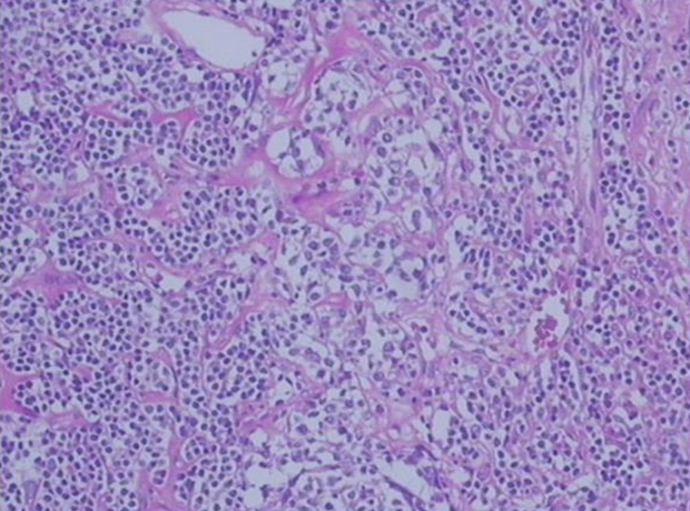 Hematoxylin and eosin staining. Deposit of red-stained substance can be seen in germinal center of some lymphoid follicles. There are significantly more interfollicular small vessels often accompanied by hyaline degeneration. There is a large amount of scattered infiltration of plasma cells around the proliferative follicles.