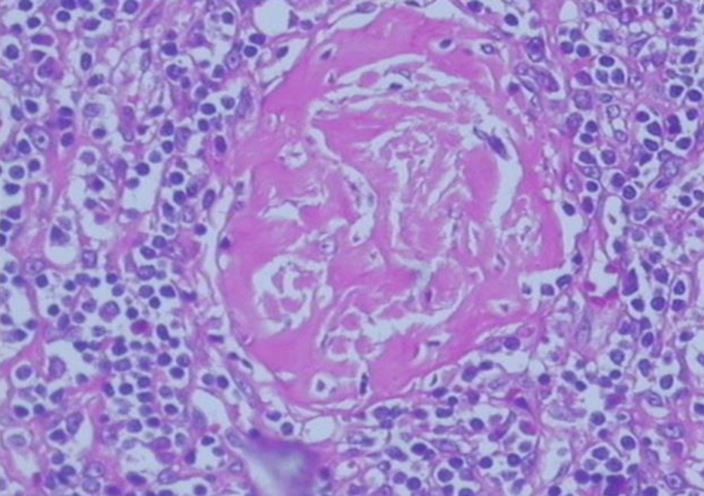 Hematoxylin and eosin staining. Enlarged lymph node.