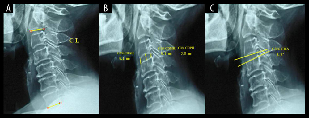 The CL, CDH, and CDA measurement methods in lateral X-ray images. (A) CL was defined as the angle formed by the lower endplates of C2 and C7, with lordosis defined as positive and kyphosis defined as negative. (B) CDAH was defined as the distance between the anterior point of the endplates, CDMH was defined as the distance between the middle point of endplates, and CDPH was defined as the distance between the posterior point of endplates, while CDH=(CDAH+CDMH+CDPH)/3. (C) The CDA was defined as the angle formed by the endplates of the upper and lower vertebrae.