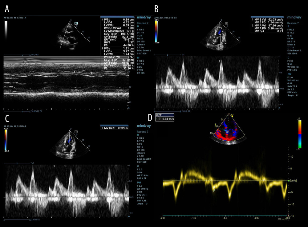 Echocardiographic assessment of left ventricular systolic and diastolic function in patients with mechanical ventilation ready for extubation. (A) Left ventricular ejection fraction (LVEF) measured for left ventricular systolic function; (B) peak early (E) and peak atrial (A) velocity transmitral flow from pulsed-wave Doppler measured for left ventricular diastolic function; (C) deceleration time of E wave (DTE) measured for diastolic function; (D) early diastolic mitral annulus velocity (e’) based on tissue Doppler imaging measured for the calculation of E/e’ ratio and left atrial pressure (LAP).