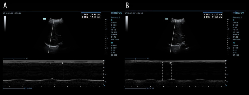 Diaphragmatic ultrasound assessment in patients with mechanical ventilation ready for extubation. (A) For normal function of the diaphragm (movement ≥1 cm); (B) for hemidiaphragmatic dysfunction (movement <1.0 cm).