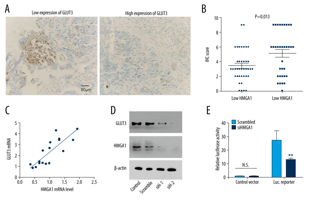 HMGA1 induced the expression and transcription of GLUT3 in CRCLM. (A) Representative IHC images of GLUT3 high and low expression. (B) Patients with high HMGA1 expression had higher IHC scores of GLUT3. The t test showed a statistically significant difference. (C) In the qPCR of 17 synchronous CRCLMs, GLUT3 expression changed along with the HMGA1 mRNA. Spearman correlation analysis showed a statistically significant difference. (D) HMGA1 knockdown substantially decreased the expression of GLUT3. In SW480 cells, HMGA1 was silenced by 2 independent siRNAs. (E) HMGA1 knockdown decreased the transcription of GLUT3. The transcription of GLUT3 was detected with luciferase in SW480 cells after silencing HMGA1.