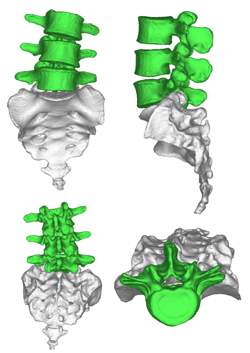 The spinal image after 3-dimensional reconstruction.