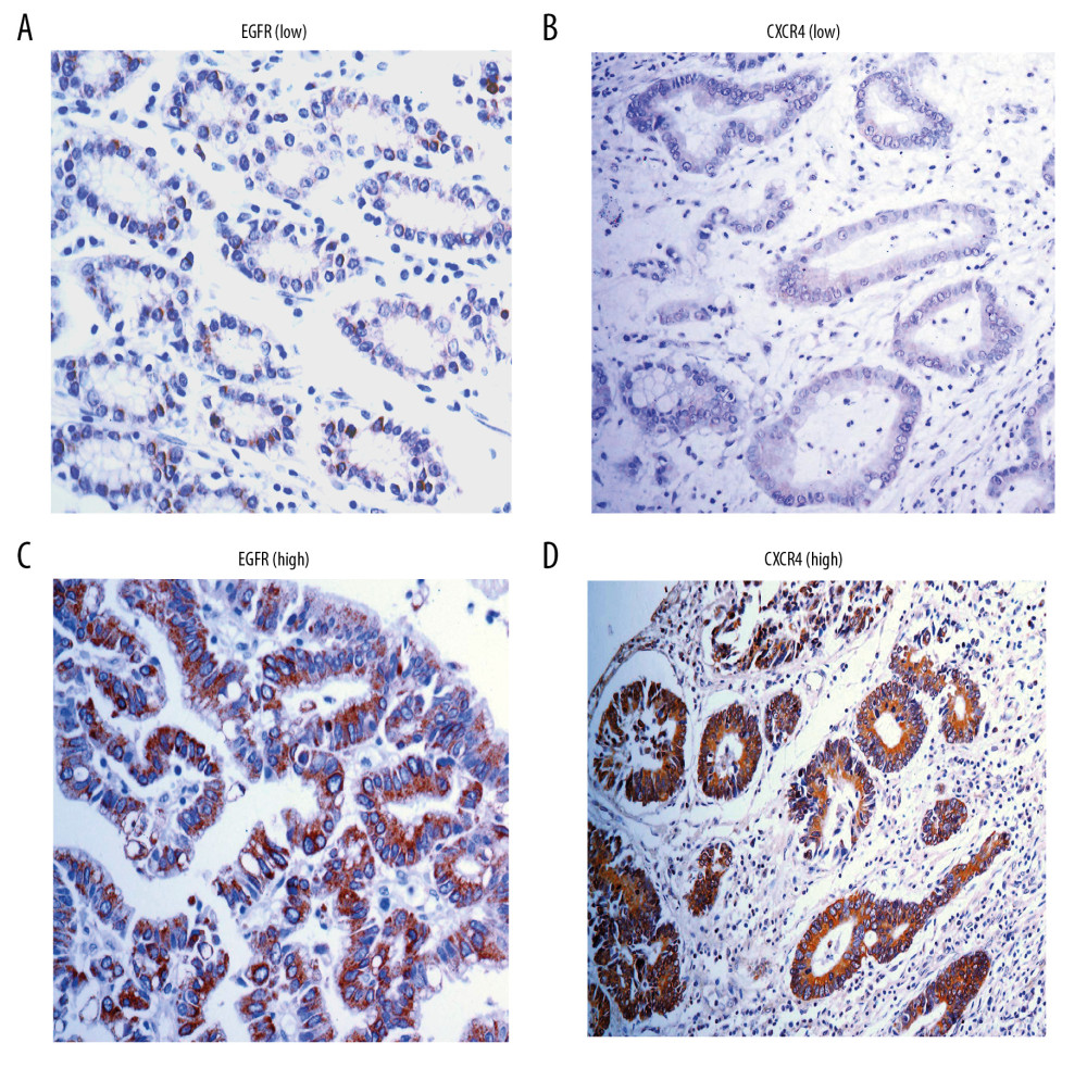 Representative images showing CXCR4 and EGFR immune-histochemical staining in gastric cancer tissues. Representative images showing CXCR4 and EGFR immunohistochemical staining in gastric cancer tissues. EGFR (A) and CXCR4 (B) low-staining levels; EGFR (C) and CXCR4 (D) high-staining levels (in brown), magnification 200×.