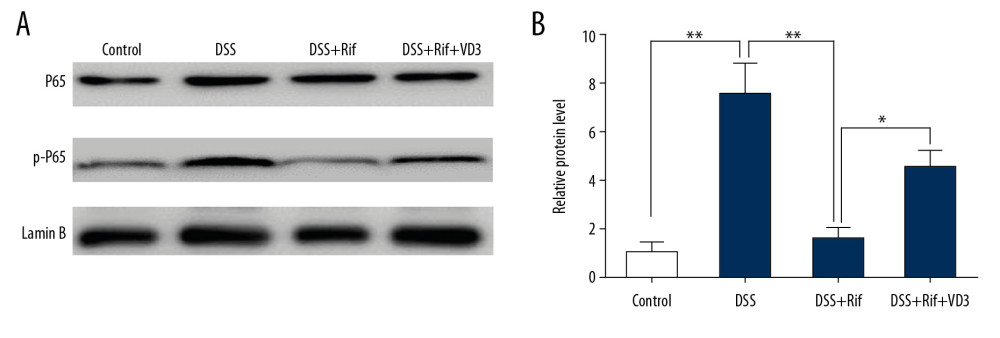 The effects VD3 on inflammatory cells colonic infiltration and NF-κB signaling in DSS-colitis mice treated with rifaximin. (A) Each protein (20 μg) was used for detection of phosphorylated p-P65 and p65. (B) ImageJ software was used to evaluate the integrated band intensity. Data are presented as relative values using corresponding p-P65, p65, and Lamin B as internal reference with the mean±SD. n=5 independent experiments from each mouse. * P<0.05, ** P<0.01.