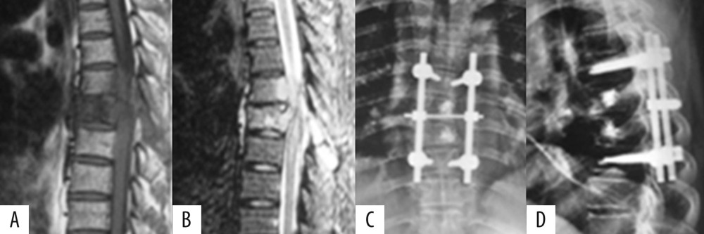 A 52-year-old male with spinal metastases from lung cancer. (A, B) Preoperative magnetic resonance imaging showed spinal metastases in T6 and T7 vertebral body. Spinal cord was compressed. (C, D) Postoperative x-ray photographs showed nodular high-density bone cement images in vertebral body of T6, T7, and L1, posterior screw fixation in T5 and T8 vertebral body. Vertebral collapse and the adjacent intervertebral space narrowed were not seen.